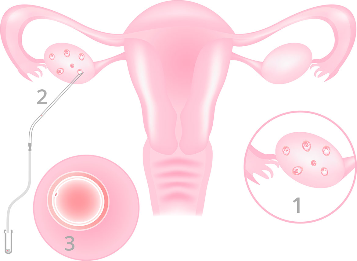 What is egg vitrification or freezing?